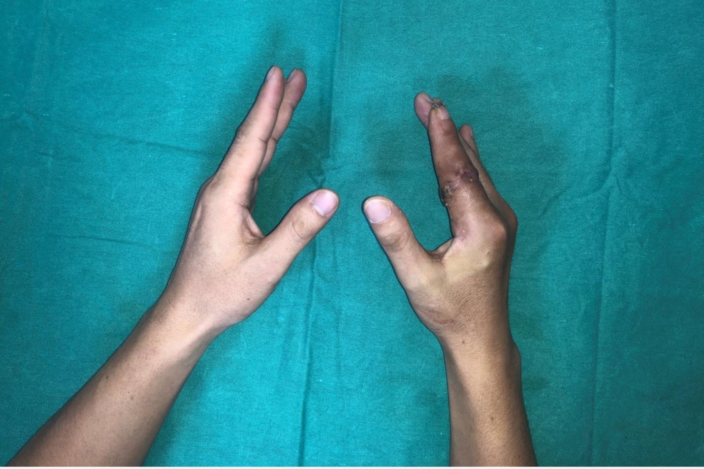 برای اولین بار، پزشکان ویتنامی با موفقیت جراحی میکروسکوپی را برای «نجات» انگشت قطع شده یک بیمار پس از ۲۵ ساعت انجام دادند - عکس ۲. Lần đầu tiên bác sĩ Việt Nam vi phẫu thuật thành công 'cứu' ngón tay bệnh nhân đứt rời sau 25 giờ- Ảnh 2.