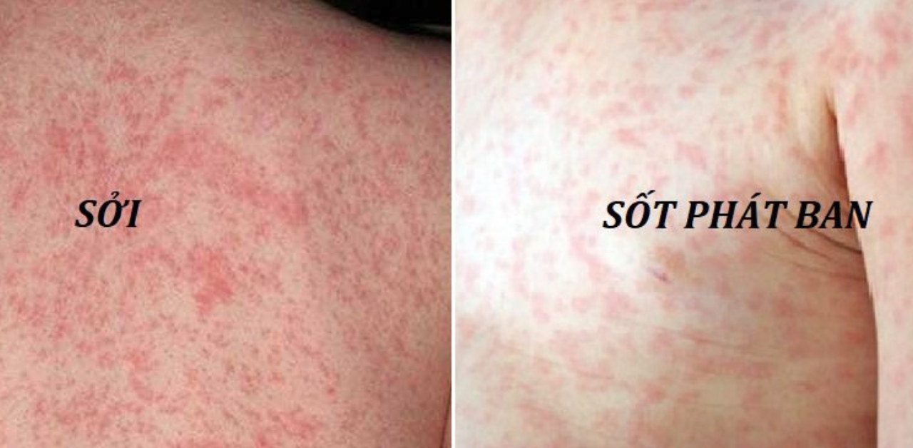 Tự ý dùng kháng sinh khi mắc sởi có thể làm bệnh nặng hơn- Ảnh 1. Tự ý dùng kháng sinh khi mắc sởi có thể làm bệnh nặng hơn- Ảnh 1.