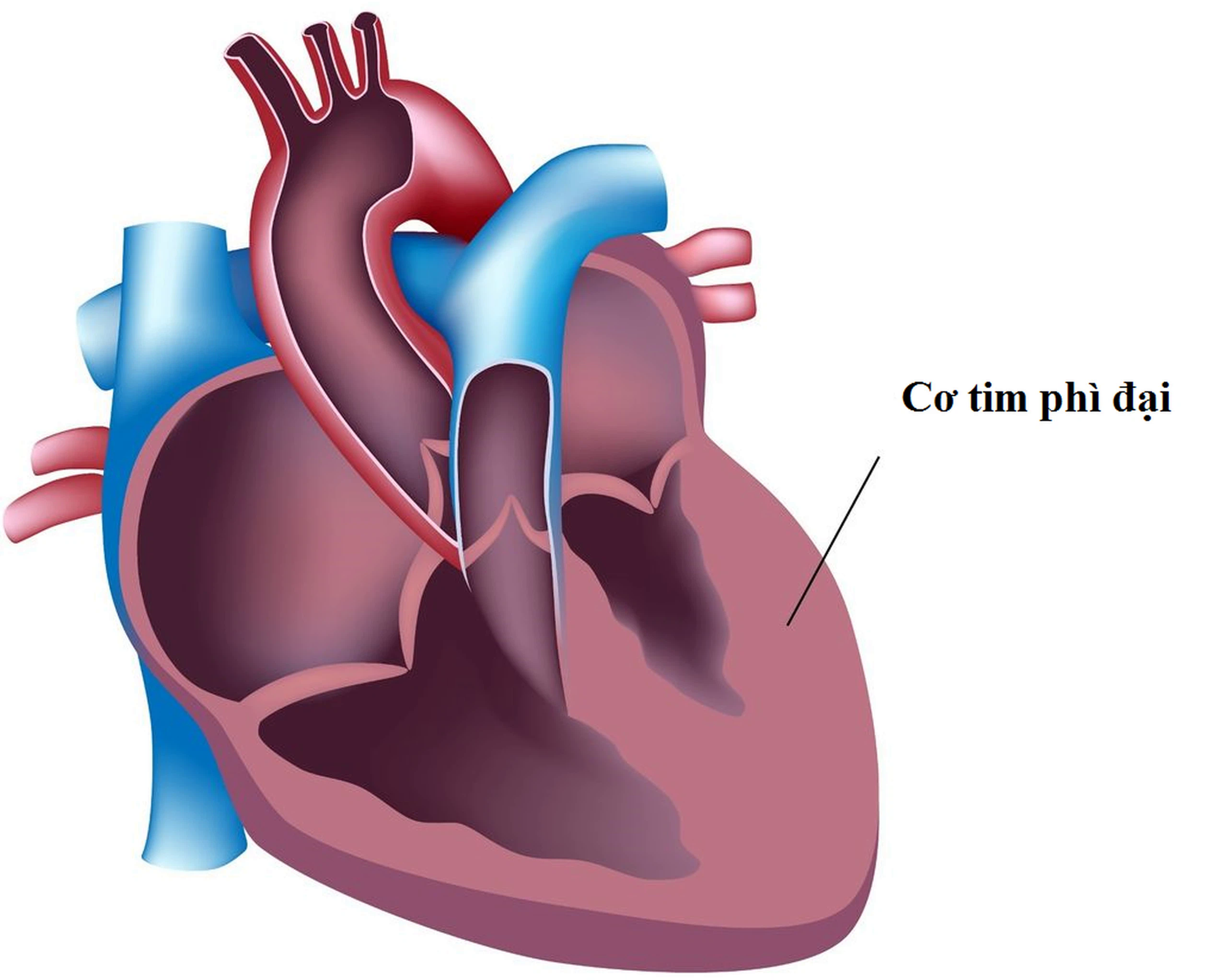 Cơ tim phì đại: Nguyên nhân, biểu hiện, cách điều trị và phòng bệnh- Ảnh 1.