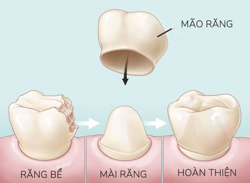 Cách nào hạn chế răng sứ xỉn màu?- Ảnh 1.