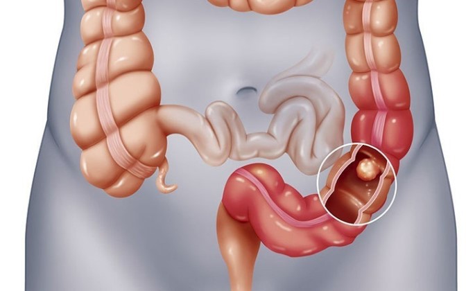 Đau bụng kéo dài không rõ nguyên nhân: Cảnh giác với viêm túi thừa Meckel- Ảnh 3.