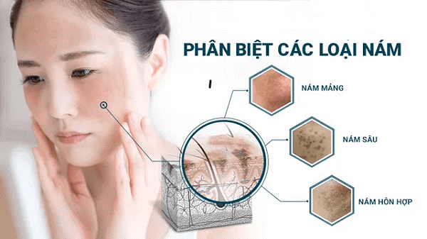 Làm sao để không bị tái nám da sau điều trị?- Ảnh 1.