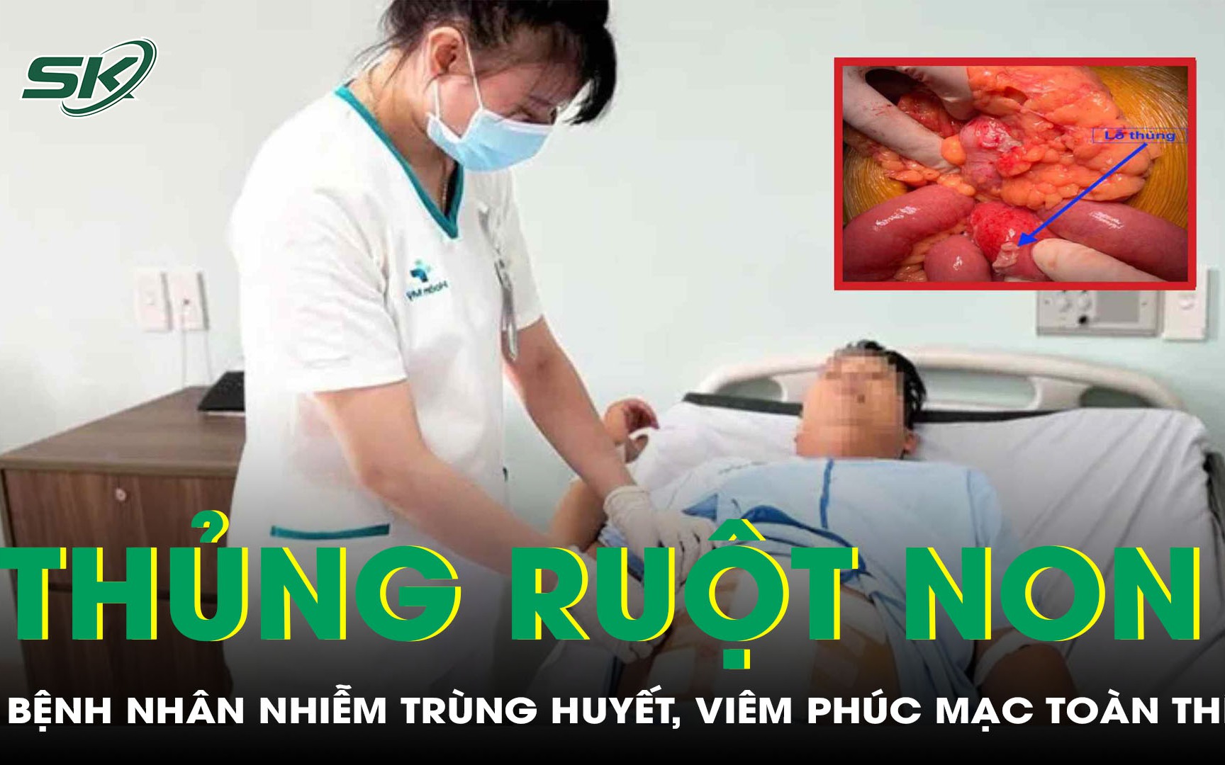 Phẫu thuật cho bệnh nhân bị nhiễm trùng huyết nặng, viêm phúc mạc toàn thể do thủng ruột non 