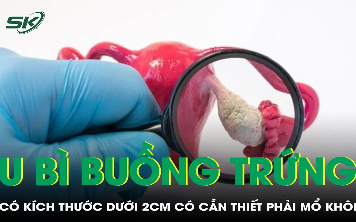 Cứu buồng trứng cho bé gái 9 tuổi nhờ phẫu thuật nội soi kịp thời- Ảnh 2. U bì buồng trứng kích thước dưới 2cm có cần thiết phải mổ không?