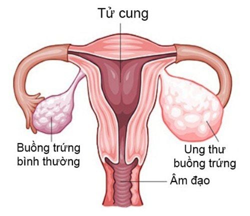 4 quan niệm sai lầm về ung thư buồng trứng- Ảnh 1.