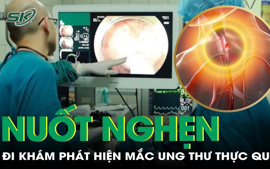 Những bài tập cơ vùng cổ họng cho người lớn tuổi có dấu hiệu khó nuốt- Ảnh 3. Khó nuốt kéo dài sau tết, người đàn ông phát hiện ung thư thực quản