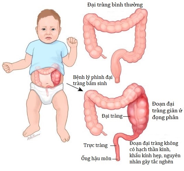 Người đàn ông 'chửa phân' do mắc căn bệnh bẩm sinh phức tạp- Ảnh 1.