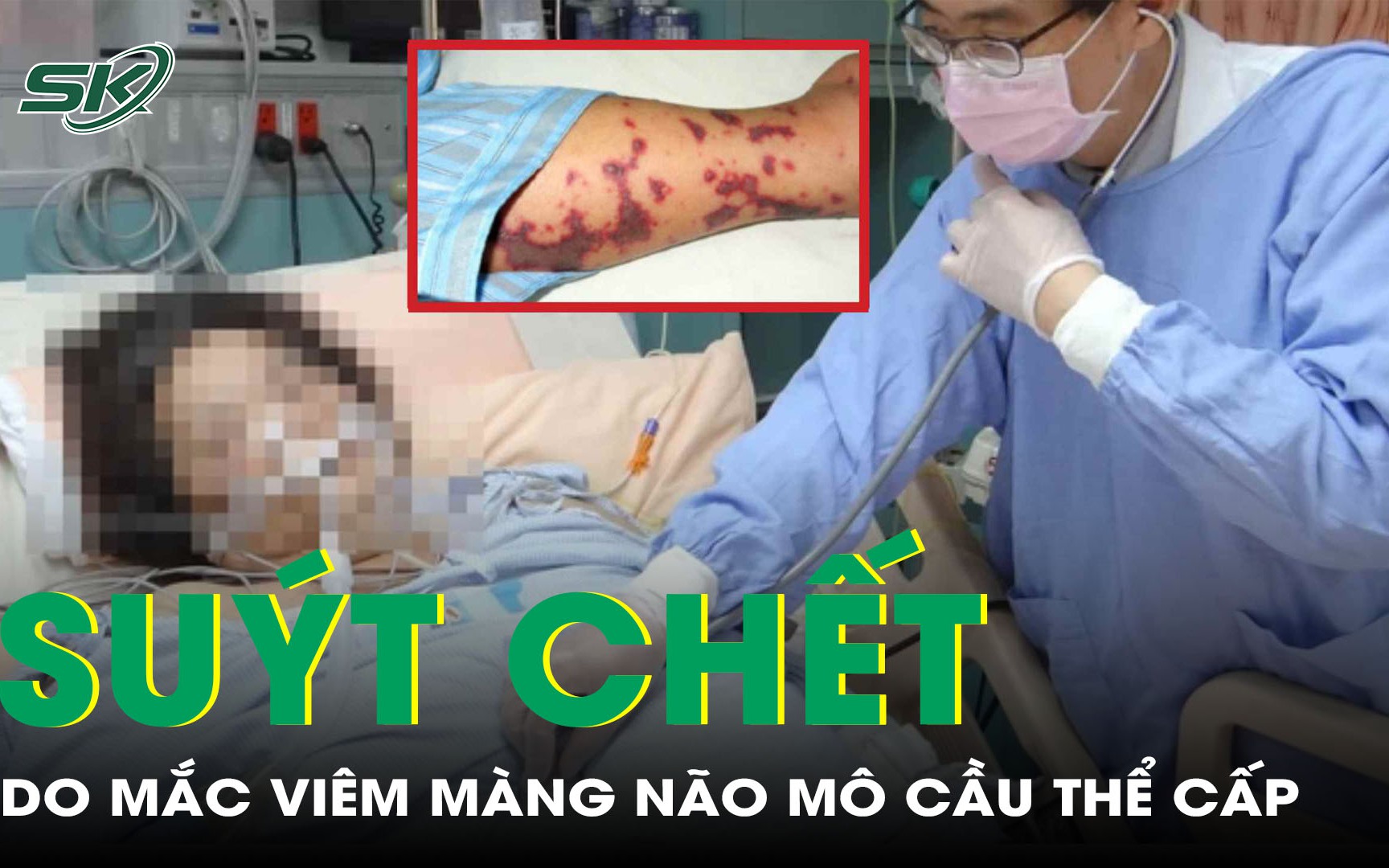 Người phụ nữ thoát chết trong gang tấc vì viêm màng não mô cầu thể cấp 