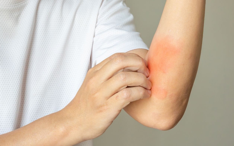 Dị ứng thức ăn làm sao để nhận biết?