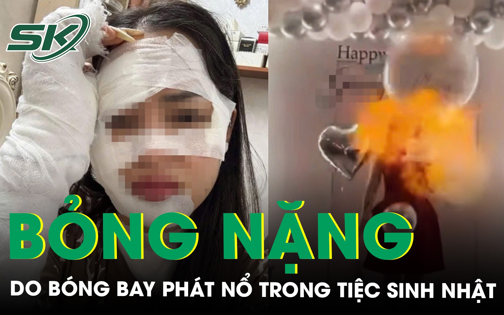 Cô gái bỏng nặng do bóng bay phát nổ trong tiệc sinh nhật, chuyên gia lên tiếng cảnh báo