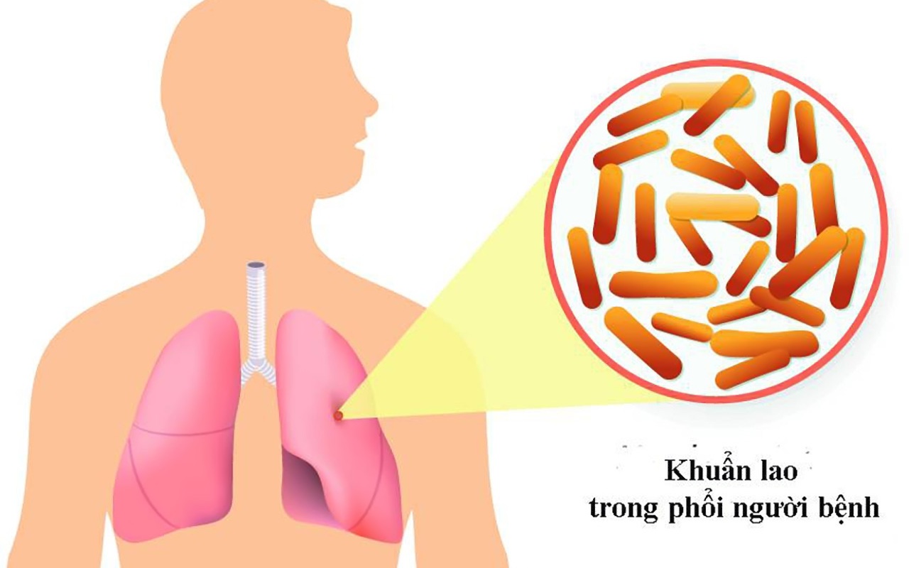 Bệnh nhân suy hô hấp nặng, nguy kịch do lao phổi tái phát 