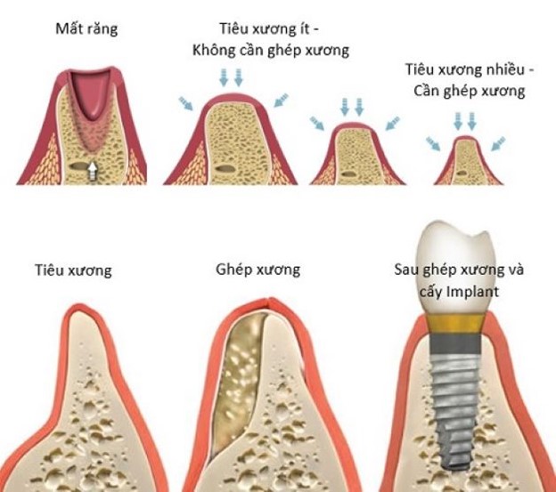 Ai cần ghép xương trong cấy ghép implant?- Ảnh 1.