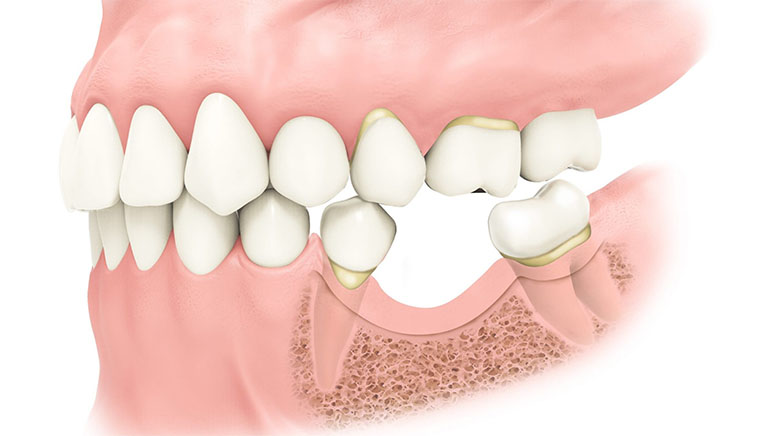 Ai cần ghép xương trong cấy ghép implant?- Ảnh 3.