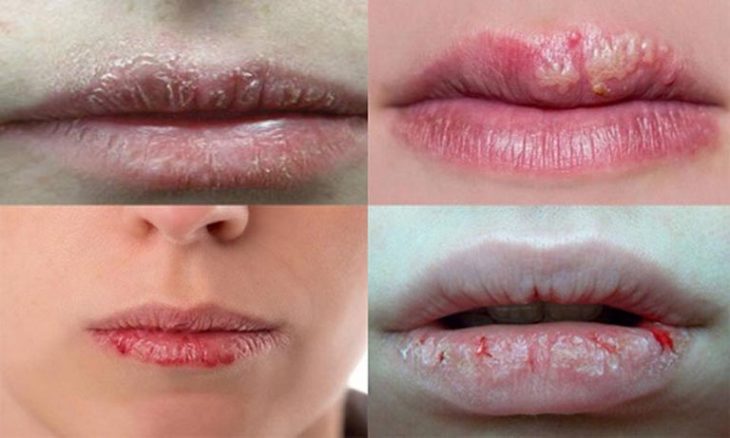 Thuốc trị mụn rộp do nhiễm herpes môi- Ảnh 1.