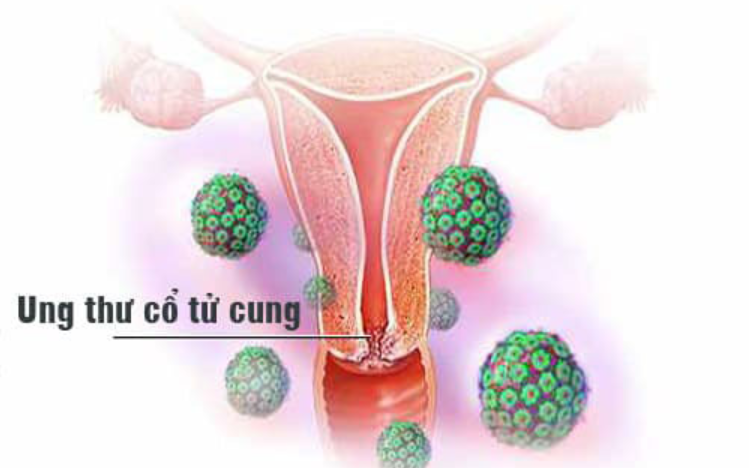 Dấu hiệu ung thư cổ tử cung qua các giai đoạn