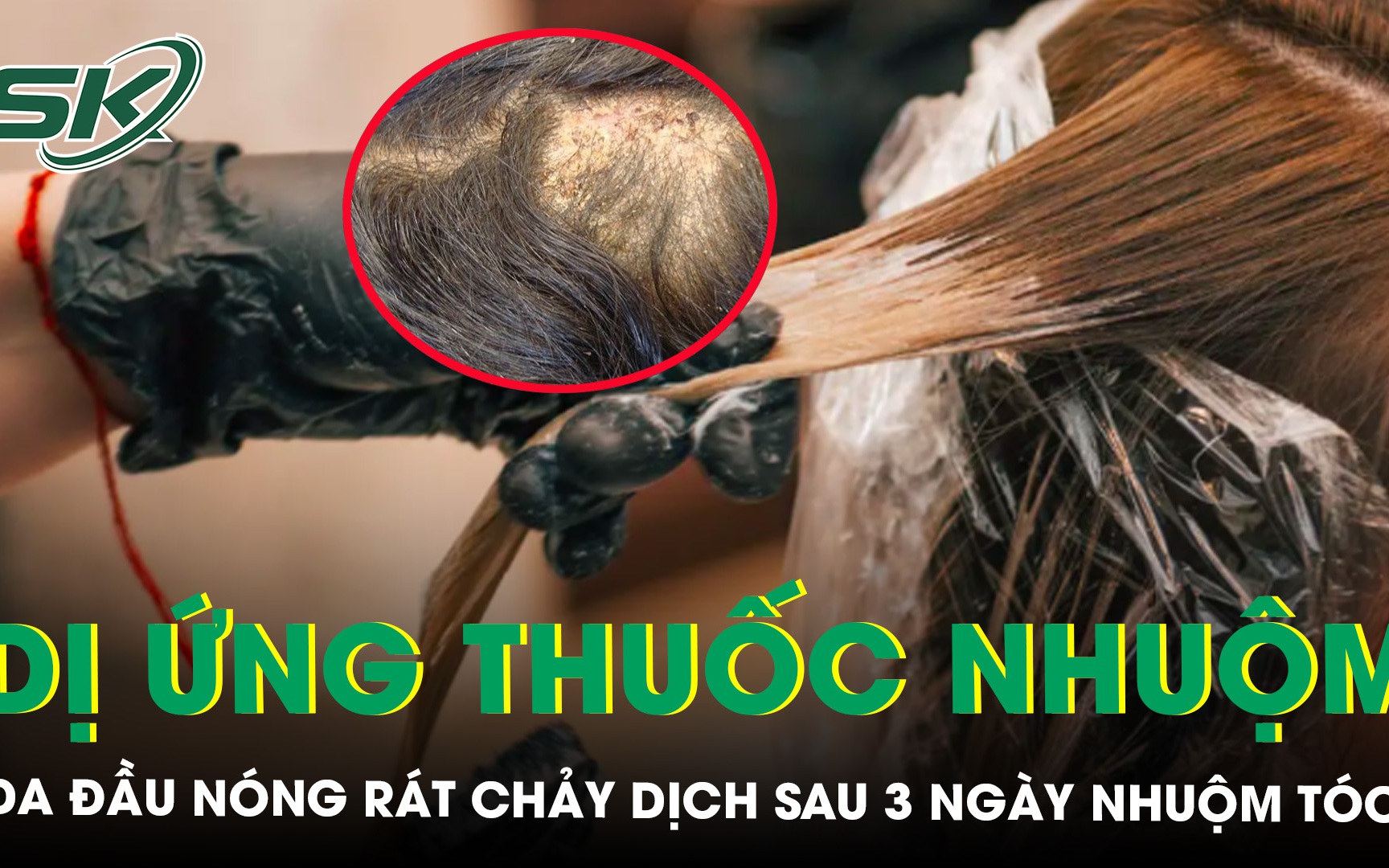 Da đầu nóng rát chảy dịch sau ba ngày nhuộm đổi màu tóc