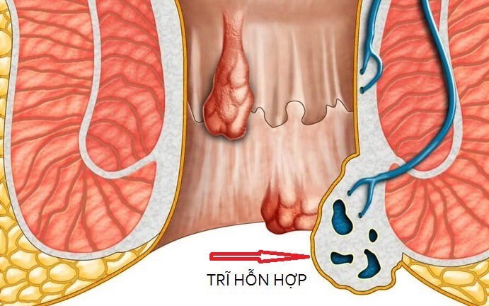 Khi nào người bệnh trĩ cần đến bệnh viện?