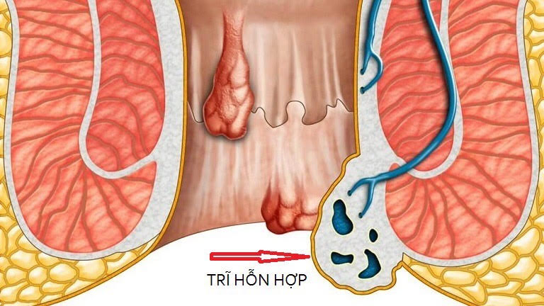 Khi nào người bệnh trĩ cần đến bệnh viện?- Ảnh 1.