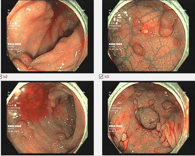 Polyp đại tràng có phải cắt không?- Ảnh 1.