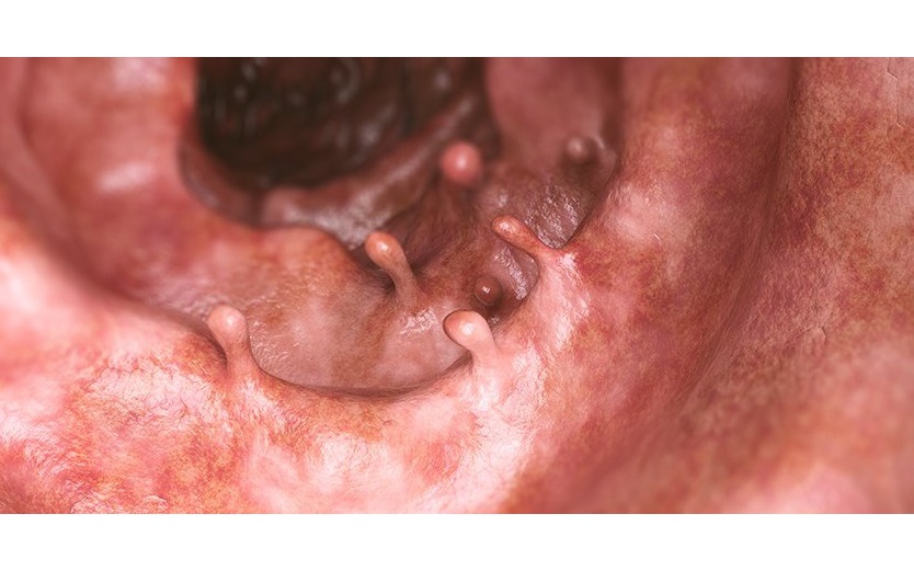 Polyp đại tràng có phải cắt không?