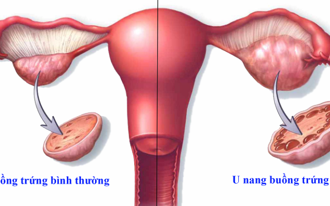 Phụ nữ cần đi khám phụ khoa định kỳ để phát hiện căn bệnh nguy hiểm, ít triệu chứng này