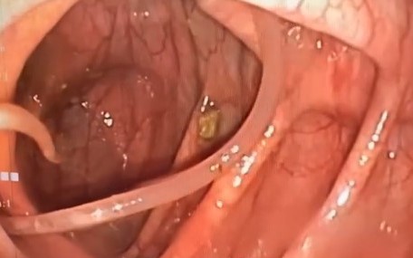 Các thói quen khiến bạn dễ mắc giun đũa và cách phòng ngừa