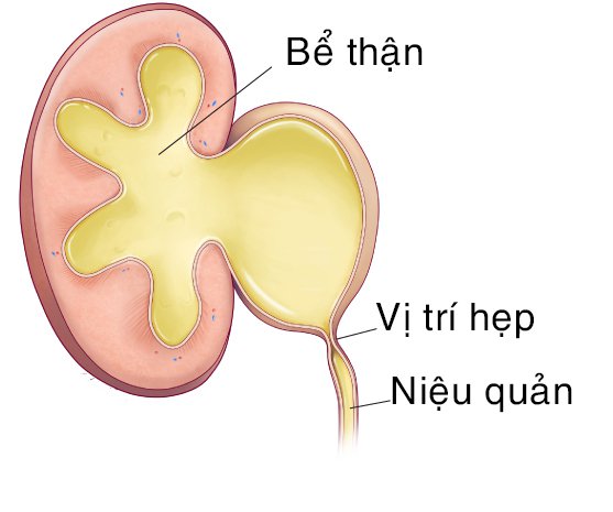 8 câu hỏi thường gặp liên quan đến hẹp niệu quản- Ảnh 1.