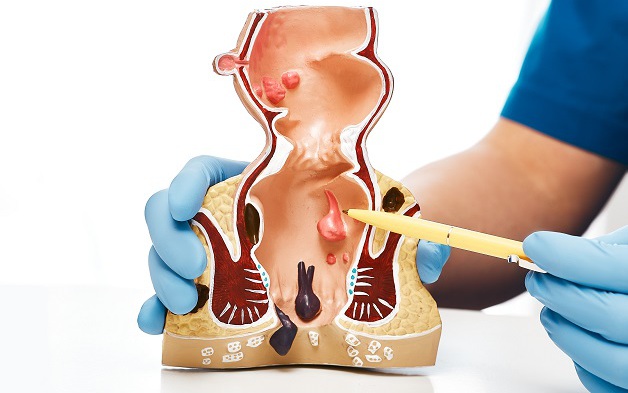 Nhận biết sớm biến chứng của bệnh trĩ