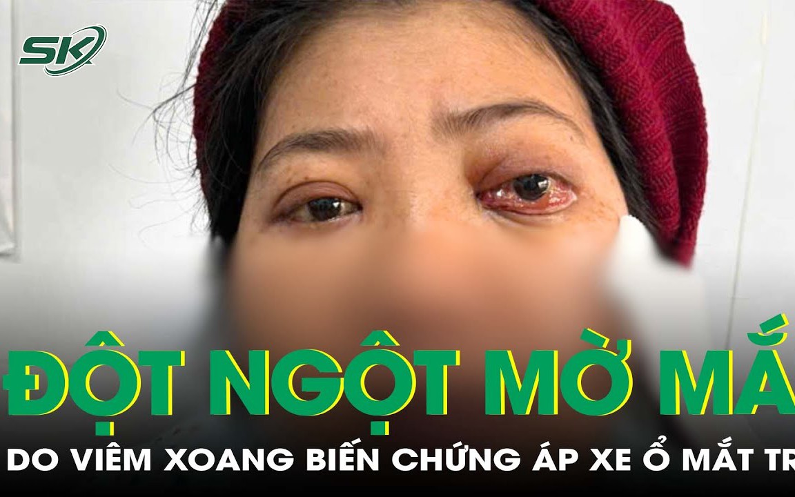 Người phụ nữ mờ mắt đột ngột do viêm xoang biến chứng