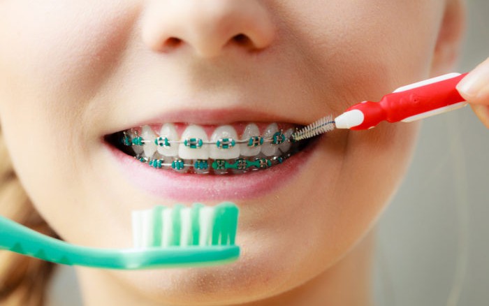 Một số lưu ý khi niềng răng để hàm răng luôn trắng khoẻ