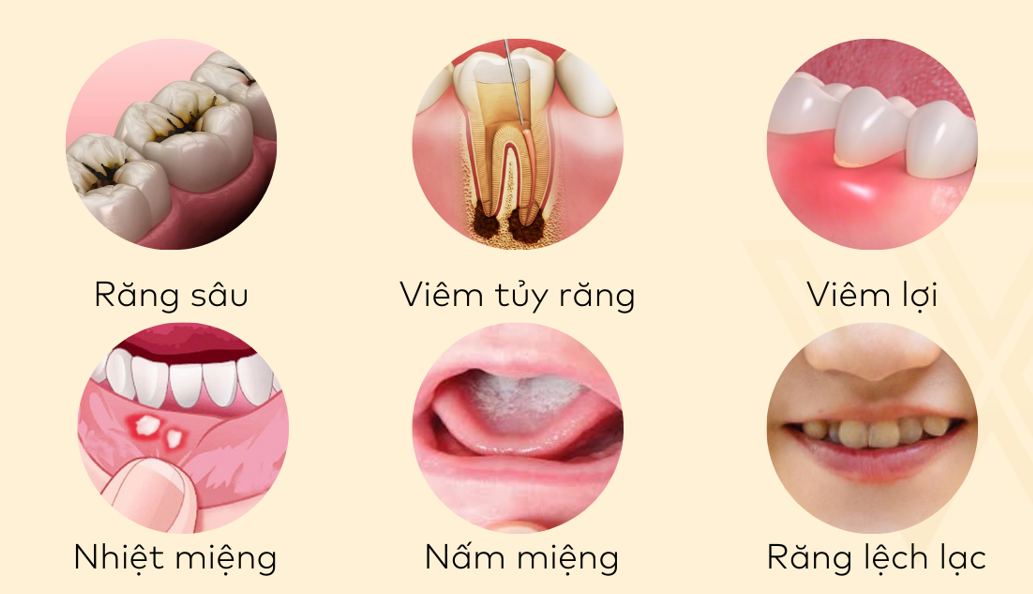 Giảm nguy cơ đột quỵ nhờ thói quen dùng chỉ nha khoa vệ sinh răng miệng- Ảnh 1.