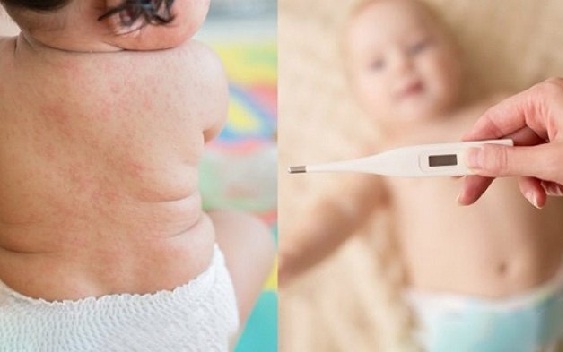 Cách phát hiện sớm sốt phát ban ở trẻ