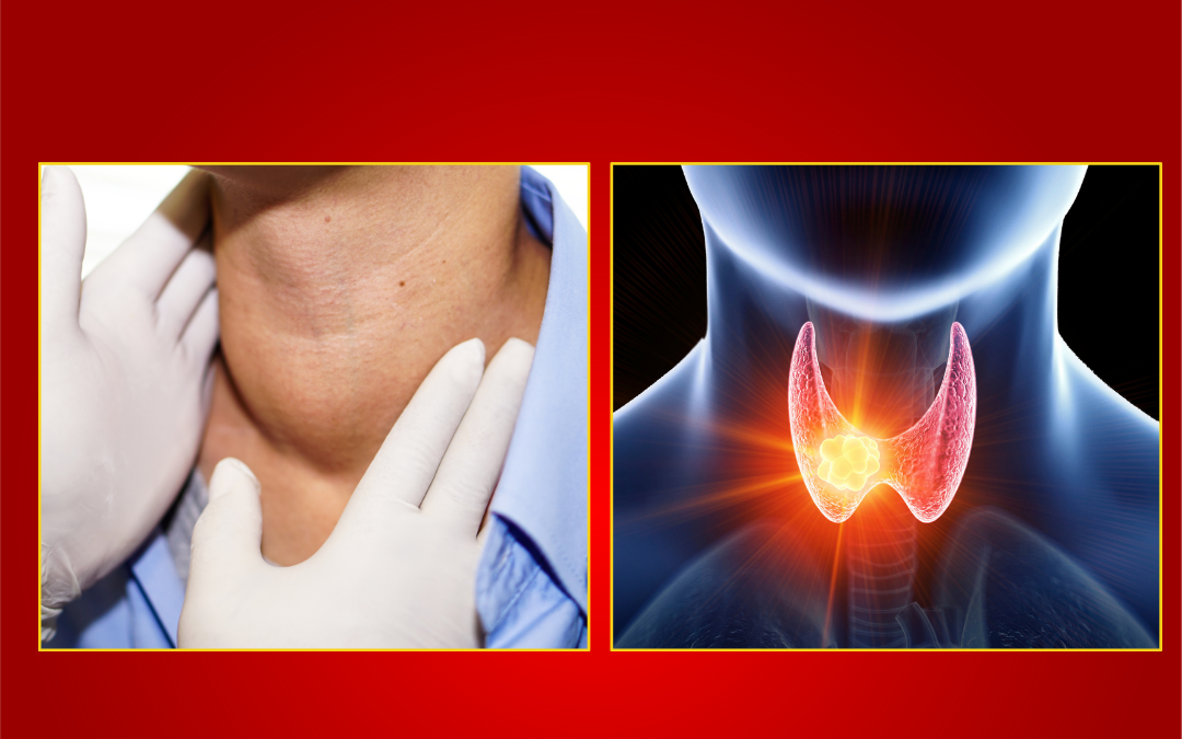 Bướu cổ đơn thuần và khối u tuyến giáp có phải là ung thư không?