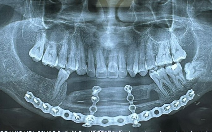 Tìm lại nụ cười bằng cấy ghép implant trên xương mác