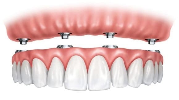 Cách phục hình hàm cho người mất răng toàn hàm- Ảnh 4.