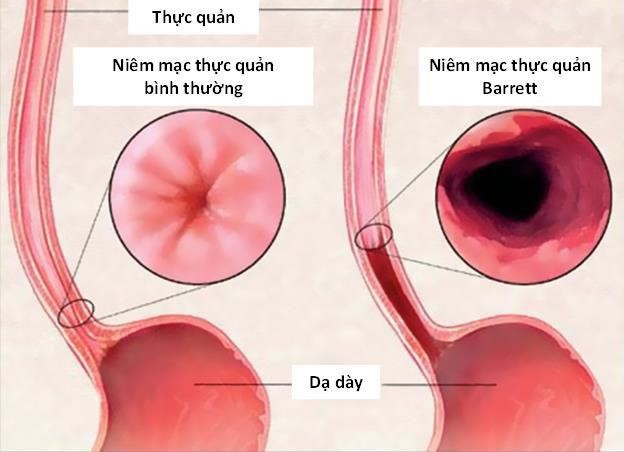 Ngăn ngừa ung thư thực quản do trào ngược bằng 'bộ đôi' Thắt tâm vị và đốt Argon Plasma- Ảnh 4.