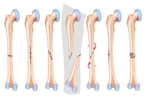 Do gãy xương hầu hết đều phải can thiệp, vì thế, để thúc đẩy quá trình điều trị, người bệnh có thể cần điều chỉnh thói quen sinh hoạt, nghỉ ngơi đầy đủ, hạn chế chuyển động của vùng bị thương… cho đến khi gãy xương lành lại.