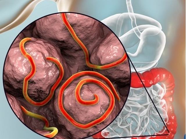 Giun kim: Nguyên nhân, biểu hiện, cách điều trị và phòng bệnh- Ảnh 1.