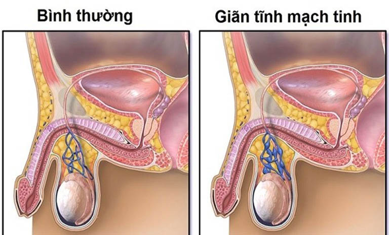 Giãn tĩnh mạch thừng tinh: Nguyên nhân, biểu hiện, cách điều trị và phòng bệnh- Ảnh 1.