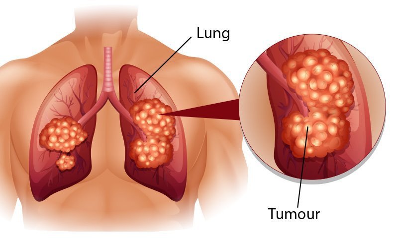 Ung thư phế quản phổi nguyên phát: Nguyên nhân, triệu chứng, cách điều trị và phòng bệnh- Ảnh 2.