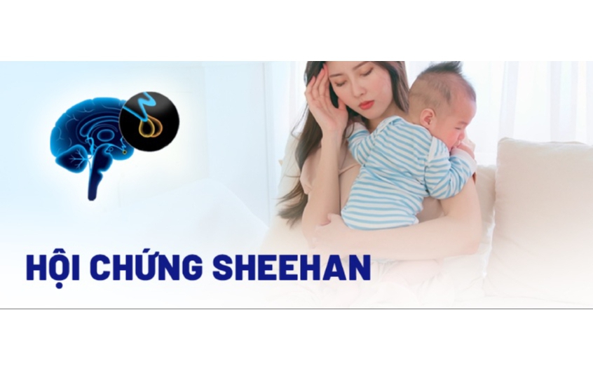 Hội chứng Sheehan: Nguyên nhân, triệu chứng, cách điều trị và phòng ngừa