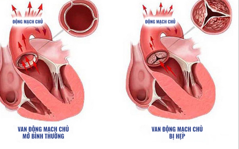 Hẹp van động mạch chủ: Nguyên nhân, triệu chứng, cách điều trị và dự phòng