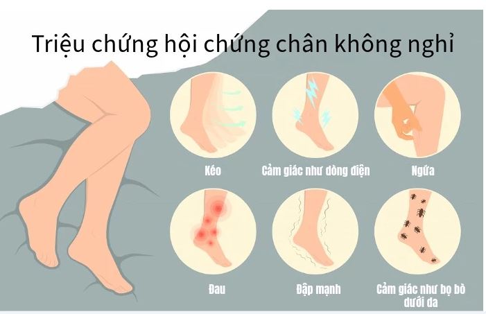 Hội chứng chân không nghỉ: Nguyên nhân, biểu hiện, cách điều trị và phòng bệnh- Ảnh 1.