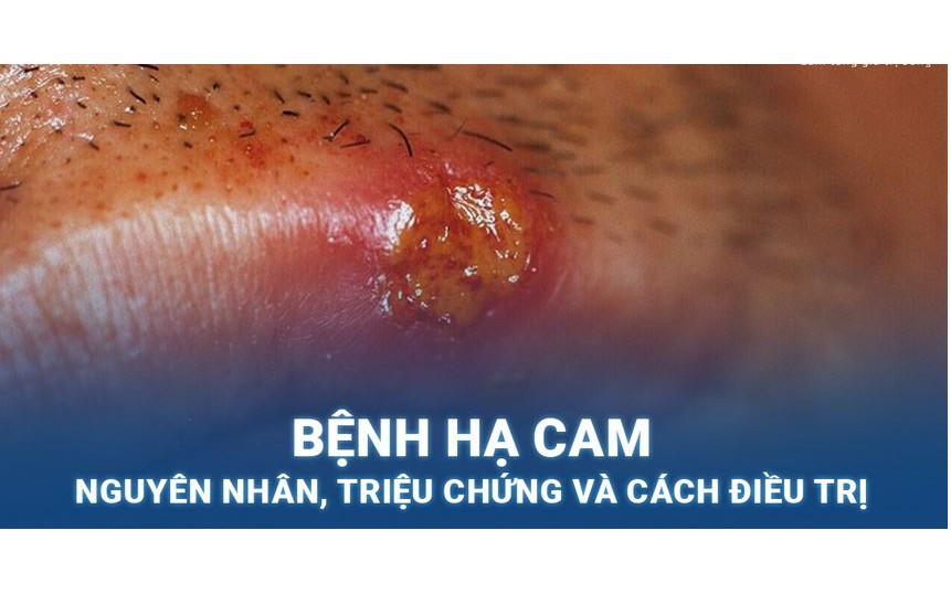 Hạ cam: Nguyên nhân, biểu hiện, cách điều trị và phòng bệnh