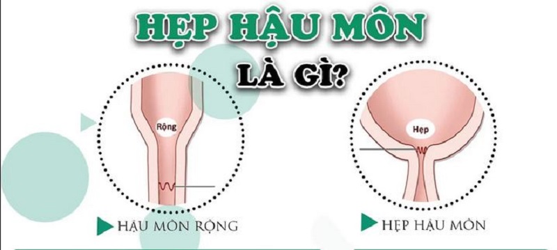 Hẹp hậu môn ở trẻ em: Nguyên nhân, biểu hiện, cách điều trị và phòng bệnh- Ảnh 1.