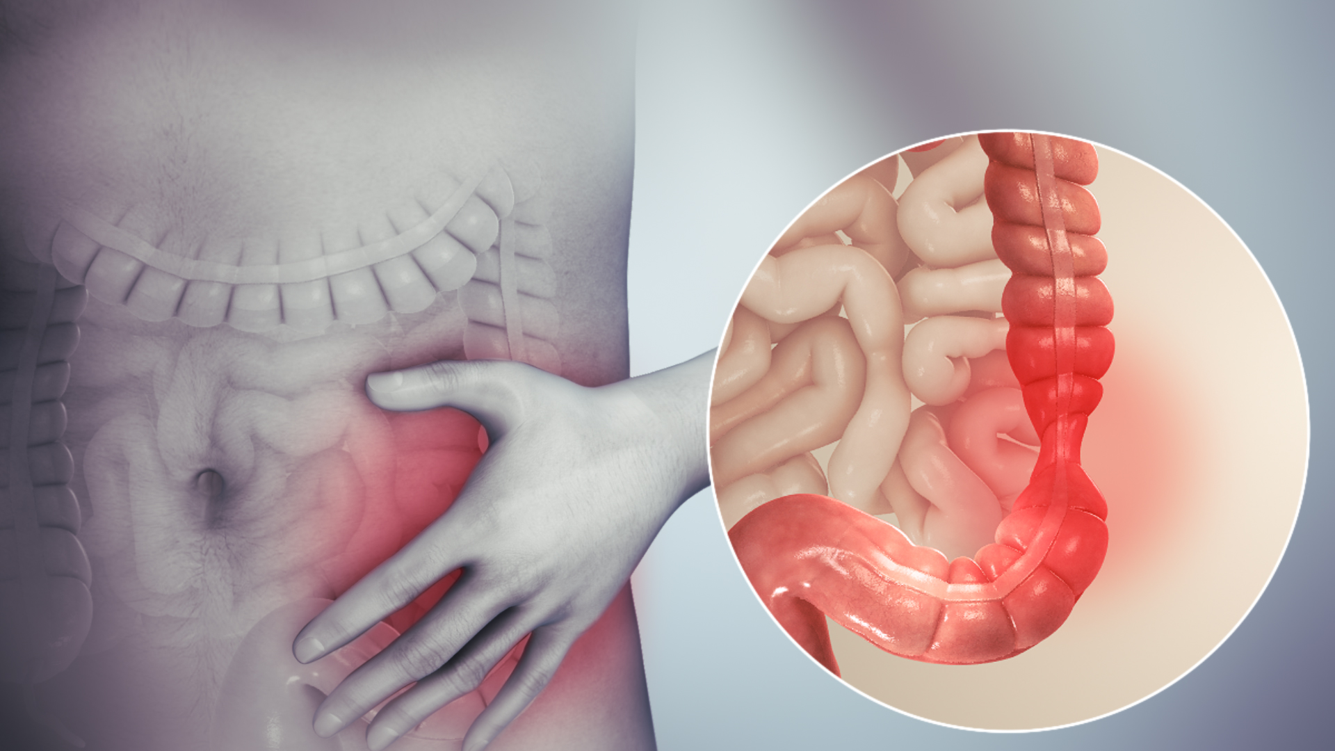 Hội chứng ruột kích thích là gì? Cách điều trị và phòng bệnh- Ảnh 1.