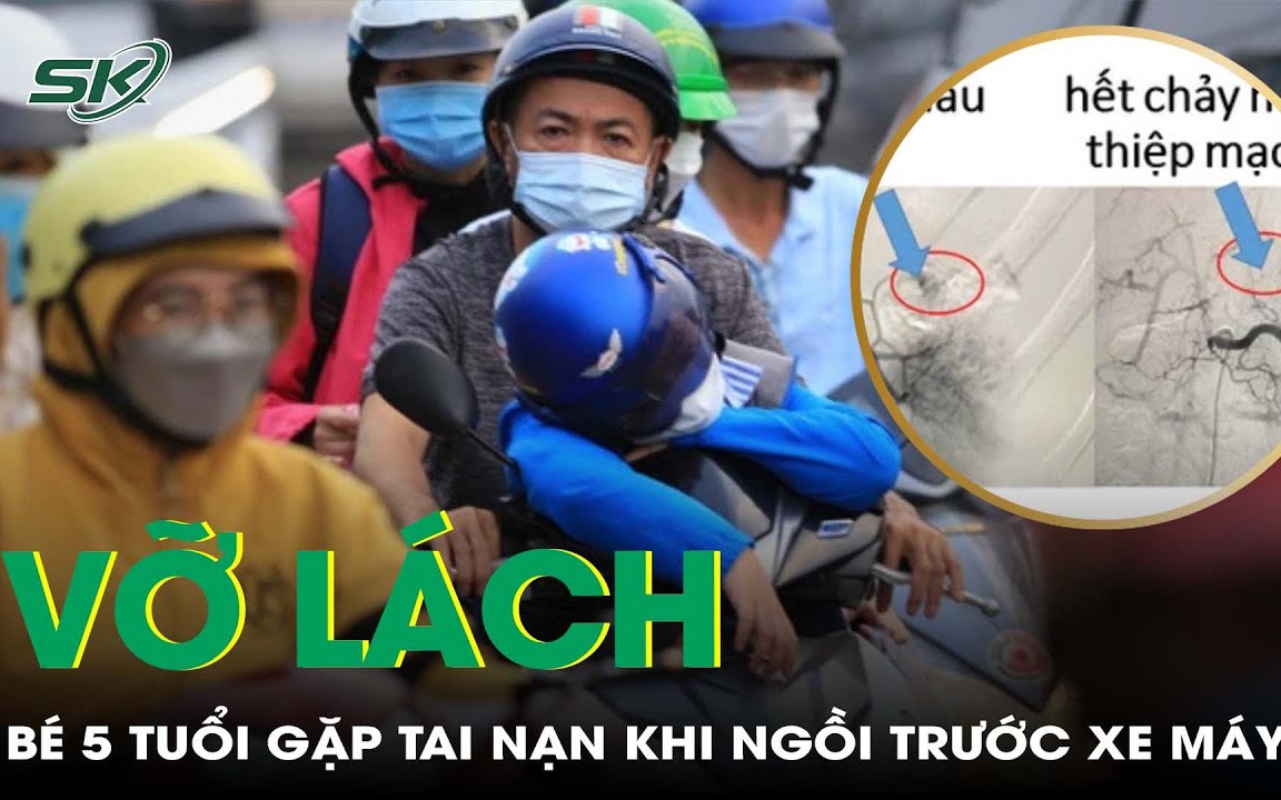 Bé 5 tuổi vỡ lách nặng sau tai nạn giao thông khi ngồi trước xe máy