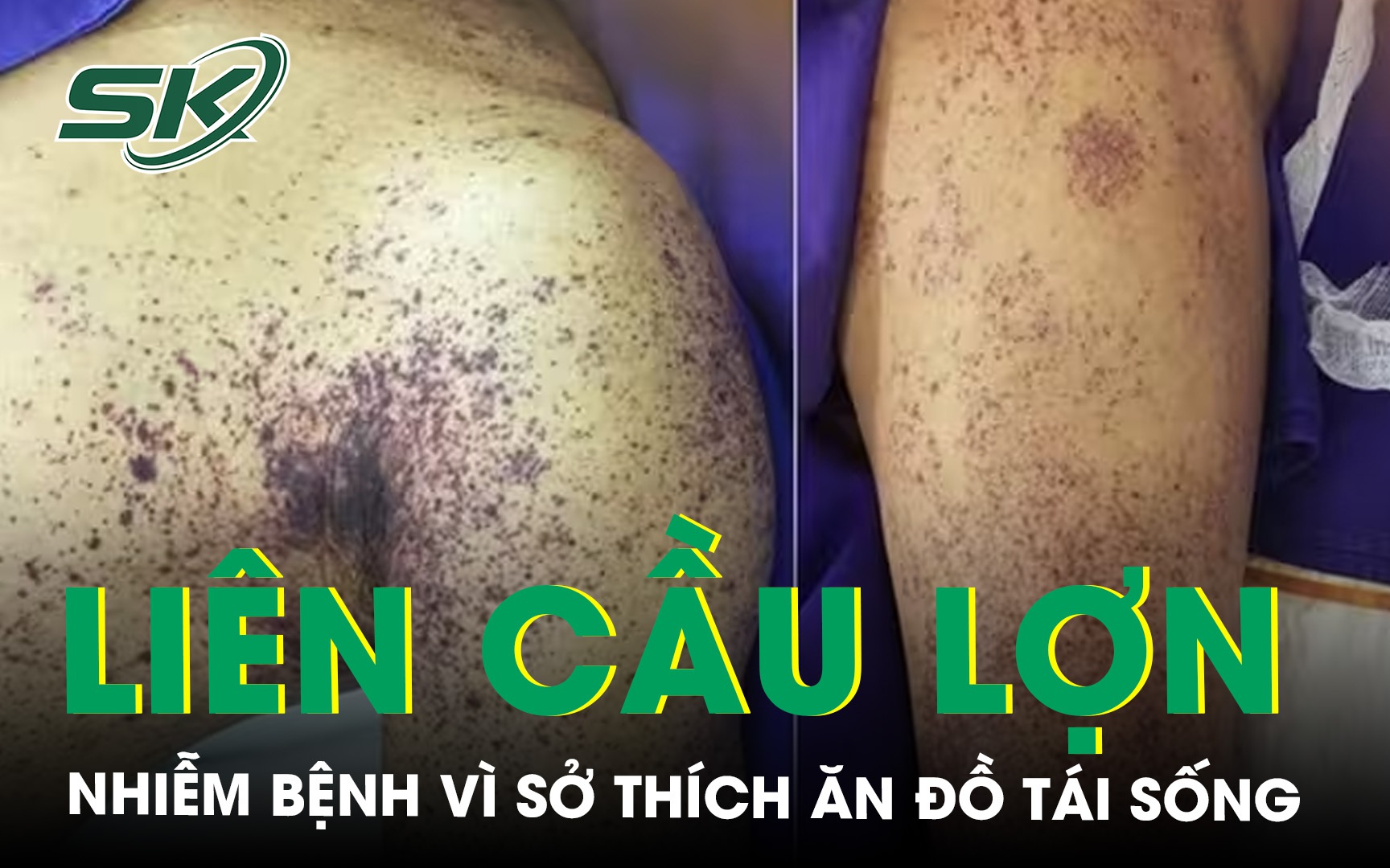 Người đàn ông nhiễm liên cầu lợn vì sở thích ăn tiết canh, đồ tái sống