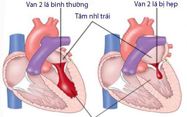 Hẹp van hai lá: Nguyên nhân, biểu hiện, cách điều trị và phòng bệnh
