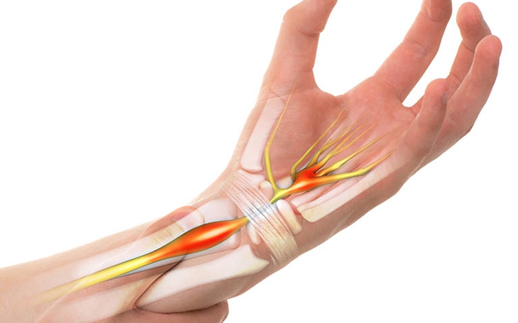 3 bệnh lý khiến tê tay ban đêm, bạn đã biết chưa? - Ảnh 2.